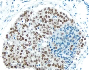 Breast Carcinoma: With Citrate-based Antigen Unmasking Solution, Estrogen receptor (rm), ImmPRESS Anti-Rabbit Ig Kit, DAB (brown) substrate. Hematoxylin QS (blue) counterstain.