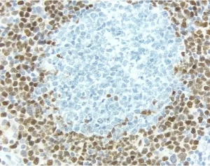 Lymph Node: With pH 9.0 Antigen Unmasking Solution, Cyclin D1 (rm), ImmPRESS Anti-Rabbit Ig Kit, DAB (brown) substrate. Hematoxylin QS (blue) counterstain.