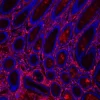 FFPE human colon carcinoma stained with Glysite Scout Glycan Screening Kit, Immunofluorescence 594 (GSK-2000, red), with colocalization of the pan-cytokeratin antibody AE1/AE3 (green). Nuclear detail was visualized by DAPI staining (blue).