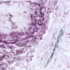 Mesothelioma (double label): M2A Antigen (m), VECTASTAIN Universal Elite ABC Kit, Vector VIP substrate (purple); CD34 (m), VECTASTAIN Universal Elite ABC Kit, Vector SG substrate (blue/gray).