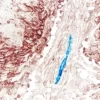 Mesothelioma (double label): M2A Antigen (m), VECTASTAIN Universal Elite ABC Kit, Vector NovaRED substrate (red); CD34 (m), VECTASTAIN Universal ABC-AP Kit, Vector Blue substrate (blue).