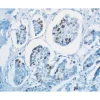 Human Breast Carcinoma: Ki67 (m), VECTASTAIN Universal Quick Kit with DAB (brown) substrate. Hematoxylin (blue) counterstain.