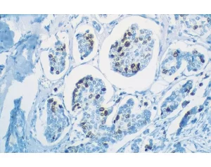 Human Breast Carcinoma: Ki67 (m), VECTASTAIN Universal Quick Kit with DAB (brown) substrate. Hematoxylin (blue) counterstain.