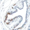 Breast Carcinoma: Progesterone Receptor (rm), ImmPRESS Universal Antibody Kit, DAB Substrate Kit (brown). Hematoxylin counterstain (blue).