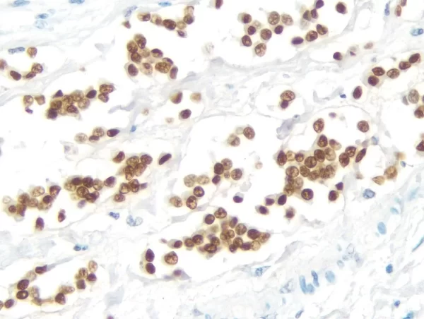 Breast Carcinoma: Estrogen Receptor (rm), ImmPRESS Universal Antibody Kit, DAB substrate Kit (brown). Hematoxylin QS counterstain (blue).