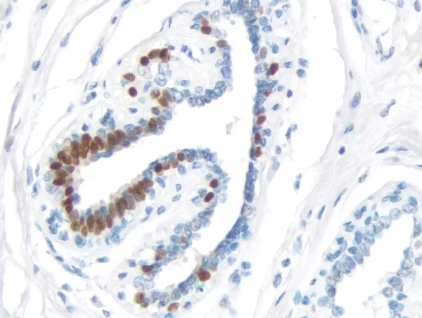 Breast Carcinoma: Estrogen Receptor (rm), ImmPRESS Universal Antibody Kit, DAB substrate Kit (brown). Hematoxylin QS counterstain (blue).