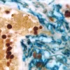 Breast Carcinoma (triple label): Estrogen Receptor (m), VECTASTAIN Elite ABC Kit, Vector NovaRED substrate (red); CD34 (m), VECTASTAIN ABC-AP Kit, Vector Blue substrate (blue); Cytokeratin 8/18 (m), VECTASTAIN Elite ABC Kit, DAB substrate (brown).