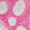Tonsil: Anti-CD45 (rat monoclonal), ImmPRESS-AP Anti-Rat IgG, Vector Red Substrate.