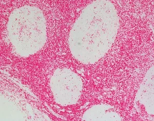 Tonsil: Anti-CD45 (rat monoclonal), ImmPRESS-AP Anti-Rat IgG, Vector Red Substrate.