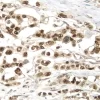 Breast Cancer: p53 protein stained using VECTASTAIN Elite ABC Kit and Vector DAB (brown) substrate. Hematoxylin QS (blue) counterstain.
