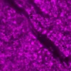 Melanoma was stained with anti-vimentin followed by ImmPRESS™-AP Anti-Rabbit IgG Reagent and Vector Blue Substrate. Note the excellent contrast of the substrate with the brown pigments.