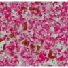 Melanoma: Anti-Vimentin (rabbit mab), ImmPRESS-AP Anti-Rabbit IgG, ImmPACT Vector Red Substrate (red).