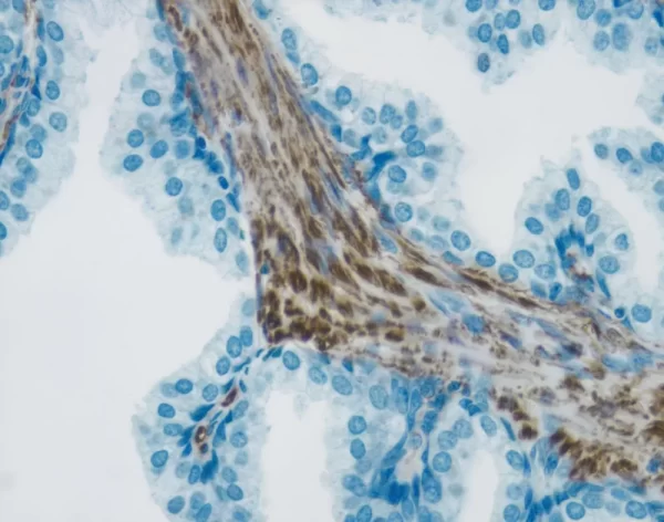 Tumor tissue section showing specific cytoplasmic cell staining (brown, Vector DAB) with Vector Hematoxylin QS (blue) counterstain.