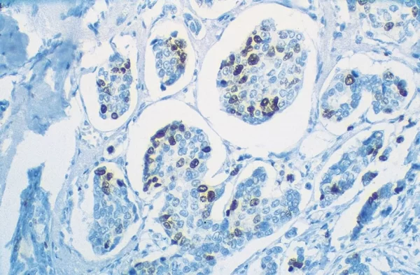 Human Breast Carcinoma: Ki67 (m), VECTASTAIN Universal Quick Kit with DAB (brown) substrate. Hematoxylin (blue) counterstain.