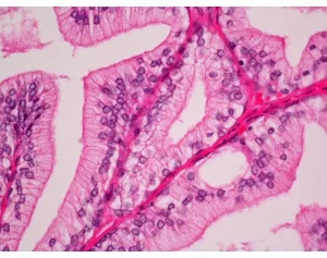 Prostate section stained with Hematoxylin & Eosin Stain Kit (cytoplasm, pink; nuclei, blue).