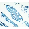 Tumor: Cytokeratin (s), VECTASTAIN Elite ABC Kit, TMB (blue).